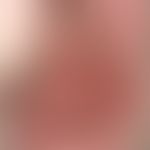 Fournier Gangrän: seltene tiefreichende Gangrän am linken Oberschenkel und gluteal bds. bei einer...