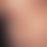 Geigerknoten. Derber, rötlich-bräunlicher, von einzelnen Komedonen durchsetzter Knoten im Kontakt...