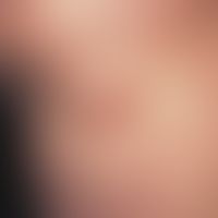 Geigerknoten. Derber, rötlich-bräunlicher, von einzelnen Komedonen durchsetzter Knoten im Kontakt...