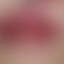 Gingivitis hyperplastica. Allmählich zunehmende, asymptomatische, knotige Verdickung der Gingiva ...