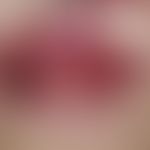 Gingivitis hyperplastica: Gradually increasing, asymptomatic, nodular thickening of the gingiva a...