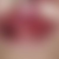 Gingivitis hyperplastica: Gradually increasing, asymptomatic, nodular thickening of the gingiva a...