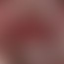 Gingivostomatitis, chronische. Scharf begrenzte, chronisch stationäre, brennende Rötung im Bereic...