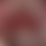 Gingivostomatitis, chronic. sharply defined, chronically stationary, burning redness in the area ...
