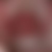 Gingivostomatitis, chronic. sharply defined, chronically stationary, burning redness in the area ...