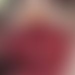 Gingivostomatitis, chronic. chronic dynamic, for 6 months alternating, extensive, highly painful ...