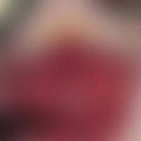 Gingivostomatitis, chronic. chronic dynamic, for 6 months alternating, extensive, highly painful ...