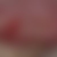 Gingivostomatitis, chronic. chronic dynamic, variable, 1.4 cm large, dolent, bizarrely configured...