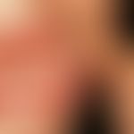 Gingivostomatitis herpetica. Gruppiert stehende aphthöse Veränderungen im Bereich der Unterlippe ...