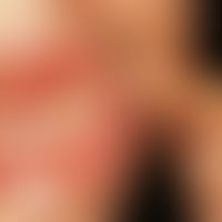 Gingivostomatitis herpetica. Gruppiert stehende aphthöse Veränderungen im Bereich der Unterlippe ...