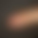 Glomus tumor, frequent, discreet finding with blue-reddish, very pressure-painful discoloration o...