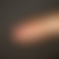 Glomustumor. Häufiger, diskreter Befund mit blau-rötlicher, sehr druckschmerzhafter Verfärbung de...