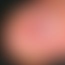 Glomustumor. Solitäre, schmerzhafte, rötliche Verfärbung unter dem Nagel des rechten Ringfingers ...