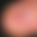 Glomus tumor. solitary, painful, reddish discoloration under the nail of the right ring finger in...