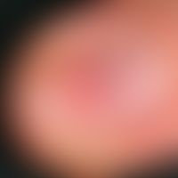 Glomustumor. Solitäre, schmerzhafte, rötliche Verfärbung unter dem Nagel des rechten Ringfingers ...