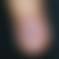 Glomustumor. Isolierter, bläulich-roter, subungual lokalisierter, kugelig protuberierender, feste...
