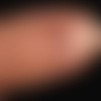 Glomustumor nach "Trepanationsversuch"
