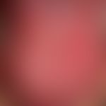 Erosive Glossitis
