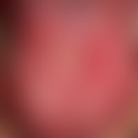 Erosive Glossitis
