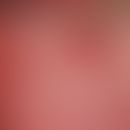 Glossitis rhombica mediana. Rhombenförmiger papillenfreier Schleimhautbezirk im mittleren Drittel...