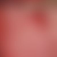 Glossitis rhombica mediana. Rhombenförmiger papillenfreier Schleimhautbezirk im mittleren Drittel...