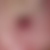 Glossitis rhombica mediana: Chronisch stationärer, seit der Geburt bestehender, schmerzloser, lei...
