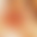 Gonoblenorrhea. Highly acute purulent conjunctivitis in adults.