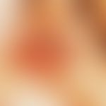 Gonoblenorrhea. Highly acute purulent conjunctivitis in adults.
