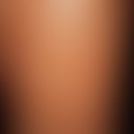 Graft-versus-Host-Disease, chronic. detailed section of thigh extensor side: extensive dermatoscl...