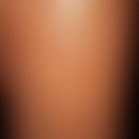 Graft-versus-Host-Disease, chronic. detailed section of thigh extensor side: extensive dermatoscl...