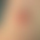 Granularzelltumor:&nbsp;Exophytischer, leicht geröteter, glatt glänzender, oberflächlich erodiert...