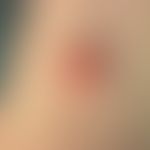 Granularzelltumor:&nbsp;Exophytischer, leicht geröteter, glatt glänzender, oberflächlich erodiert...