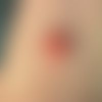 Granularzelltumor:&nbsp;Exophytischer, leicht geröteter, glatt glänzender, oberflächlich erodiert...