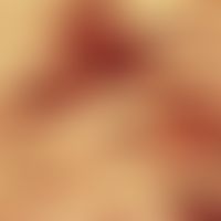 Granularzelltumor-Vergrößerung: Granuläres Zytoplasma in den spindeligen Zellen.

