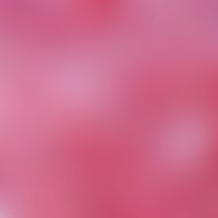 Granularzelltumor:&nbsp;Anfärbung der granulären Zellen mit S100.
