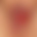 Granulation tissue. several, chronically active erosions localized at the large labia, symmetrica...