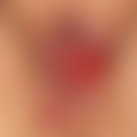 Granulation tissue. several, chronically active erosions localized at the large labia, symmetrica...