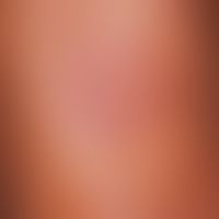 Granuloma anulare. ring-shaped, lichenoid shiny, centrifugally growing papules in the area of the...
