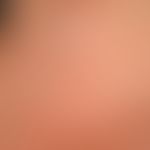 Granuloma anulare (Übersichtsaufnahme): erstmals vor 5 Jahren aufgetretene, nicht abheilende, anu...