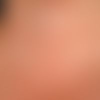 Granuloma anulare (Übersichtsaufnahme): erstmals vor 5 Jahren aufgetretene, nicht abheilende, anu...