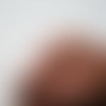 Granuloma anulare: seit Jahren bestehendes Krankheitsbild mit asymptomatischen, hautfarbenen Pape...