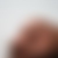Granuloma anulare, a clinical picture that has existed for years with asymptomatic, skin-coloured...