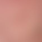 Granuloma anulare disseminatum. detail enlargement: Solitary or confluent, 0.2-1.5 cm in size, bl...