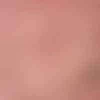 Granuloma anulare disseminatum. detail enlargement: Solitary or confluent, 0.2-1.5 cm in size, bl...
