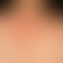 Granuloma anulare disseminatum. Übersichtsaufnahme: Nicht-schmerzhafte, nicht-juckende, dissemini...