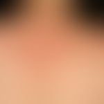Granuloma anulare disseminatum: Survey image: Non-painful, non-itching, disseminated, anular, sol...