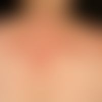 Granuloma anulare disseminatum: Survey image: Non-painful, non-itching, disseminated, anular, sol...