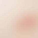 Granuloma anulare perforans. Anularly arranged, centrally ulcerated reddish papules.