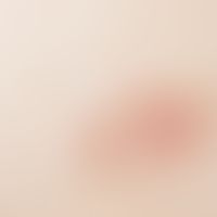 Granuloma anulare perforans. Anularly arranged, centrally ulcerated reddish papules.