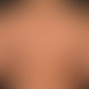 Granuloma anulare perforans. Übersichtsaufnahme: Hautfarbene bis rötliche, derbe, glatte, sich pe...